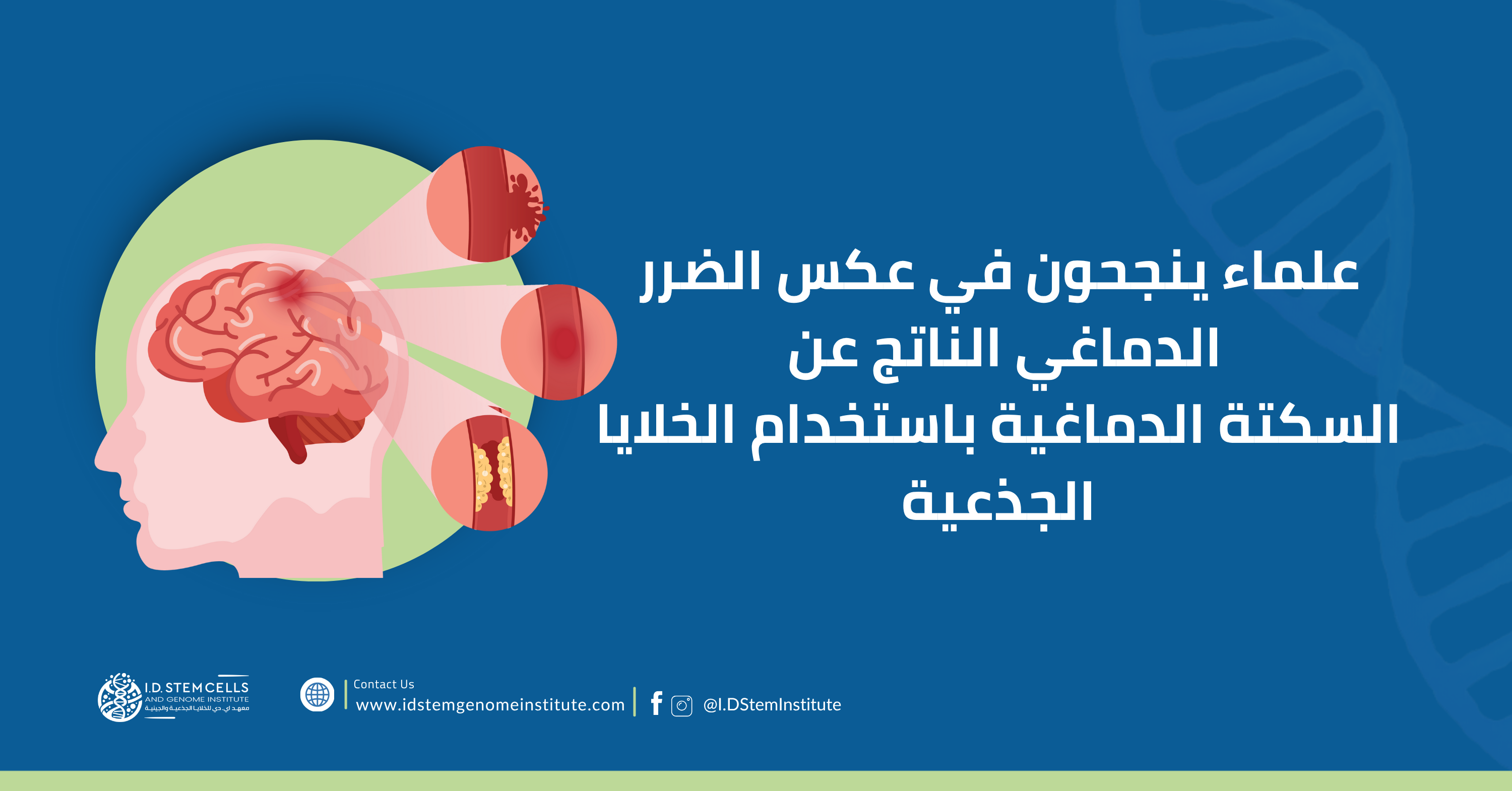 علماء ينجحون في عكس الضرر الدماغي الناتج عن السكتة الدماغية باستخدام الخلايا الجذعية
