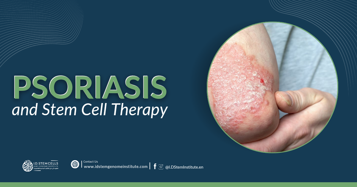 Psoriasis and Stem Cell Therapy