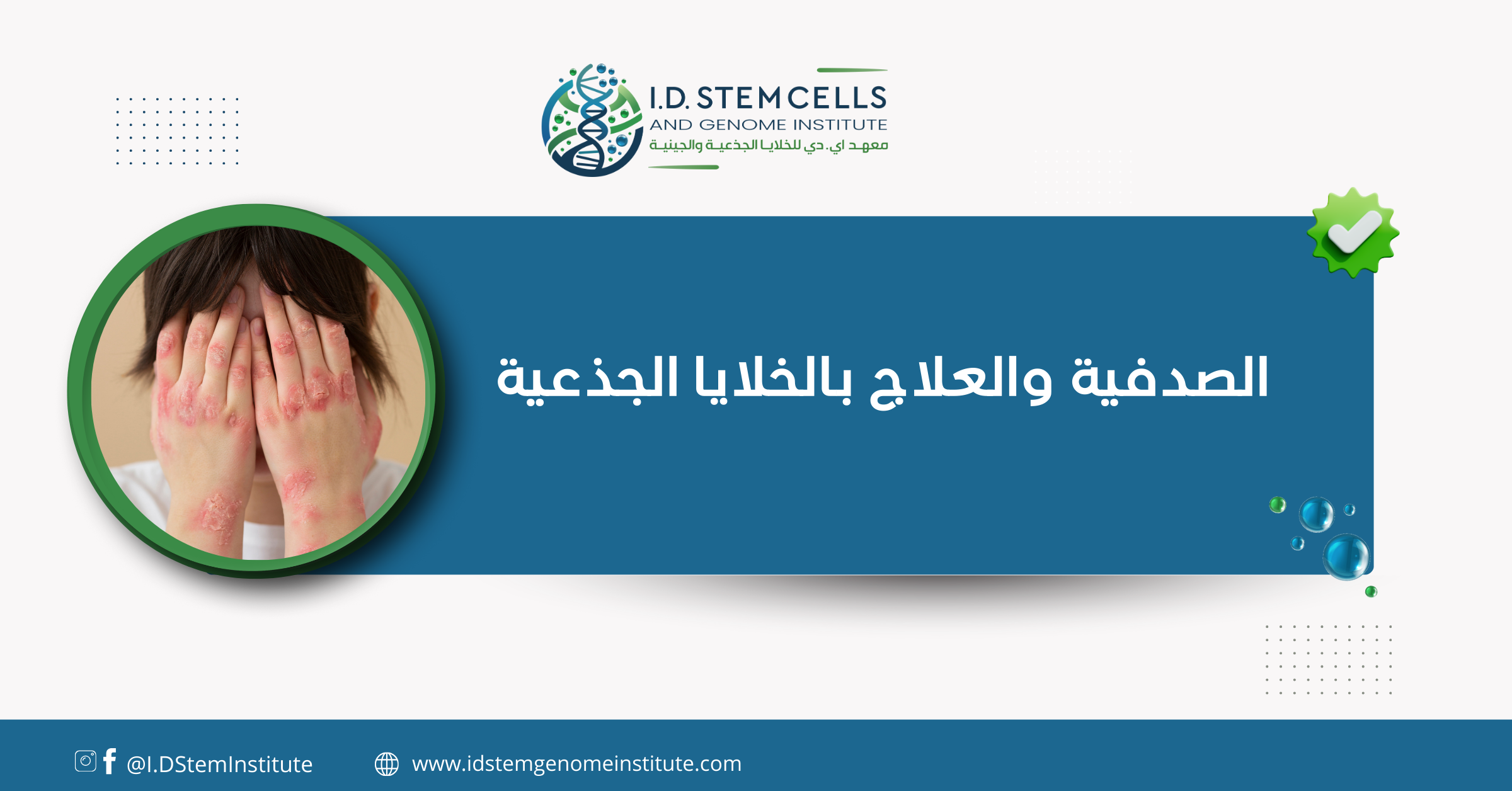  الصدفية والعلاج بالخلايا الجذعية